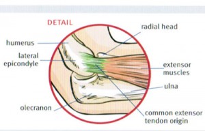Tennis Elbow and prevention - Central City Physiotherapy